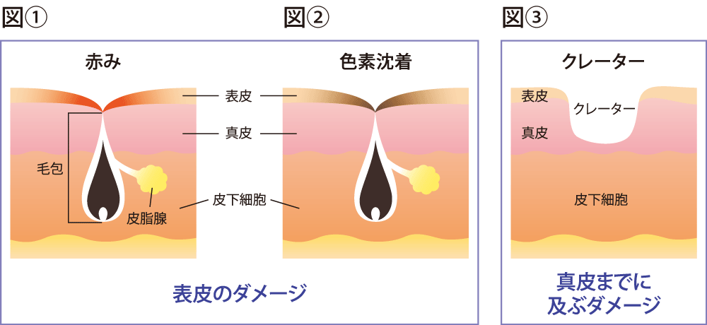 ニキビ跡の肌ダメージ図
