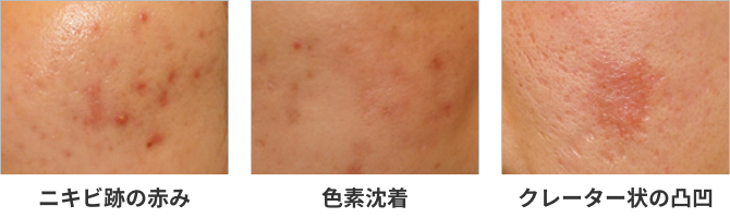 ニキビ跡3種類の肌状態写真